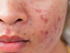 Image result for Mites On Face Rash