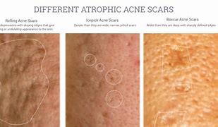 Image result for Atrophic Scar Treatment