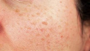 Image result for Age Spots Skin Cancer