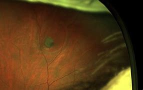 Image result for External Retinaculum