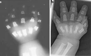 Image result for Trident Hand Achondroplasia