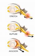 Image result for Brachial Plexus Fall Injury