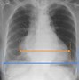 Image result for Pulmonary Edema Fluid Overload