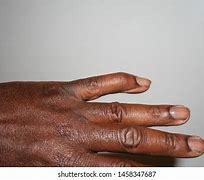 Image result for Dislocated Pinky Finger