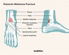 Image result for Lateral Malleolus Ligaments