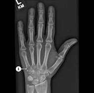 Image result for PA Finger X-ray