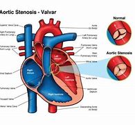 Image result for Left Ventricular Outflow Tract Stroke Volume