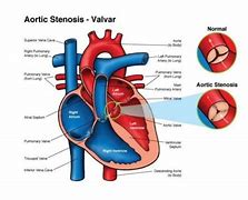 Image result for Right Ventricular Outflow Tract