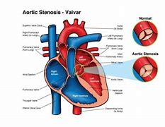 Image result for Anatomical Site of Left Ventricular Outflow Tract