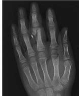 Image result for Middle Finger Tenolysis