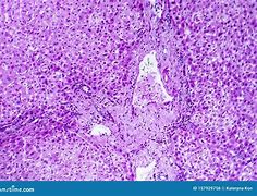 Image result for Swelling of Liver