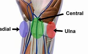 Image result for Pins in Wrist Pain