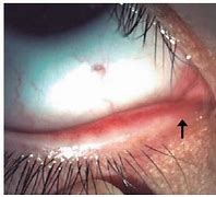 Image result for Punctal Stenosis