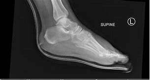 Image result for Lisfranc Orif