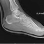 Image result for Lisfranc Orif