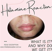 Image result for Histamine Reaction