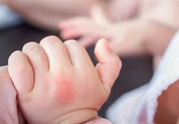 Image result for Baby Bed Bug Bites