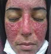 Image result for Skin Rash with Pustules