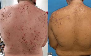 Image result for Pustules Back