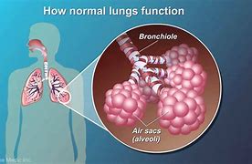 Image result for COPD 3D