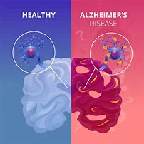 Image result for ALZ Disease