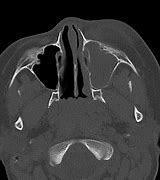 Image result for Subperiosteal Abscess Orbital Cellulitis