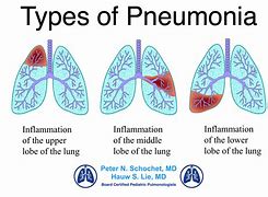 Image result for Childhood Pneumonia