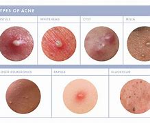 Image result for Pustule Rashes