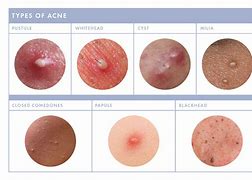 Image result for Pustule Skin Lesion