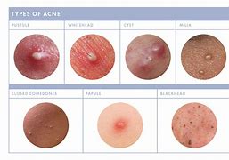 Image result for Pustule Pimple