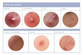 Image result for What Are Pustules On the Skin