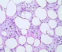 Image result for Necrosis Histology