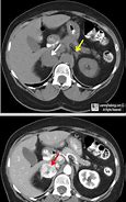 Image result for Pheochromocytoma On CT Scan