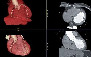 Image result for Angio Vue Choriocapillaris