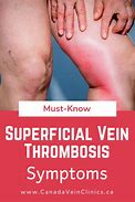 Image result for SCV Thrombosis