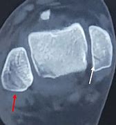 Image result for Medial Malleolus Structures Cut Section