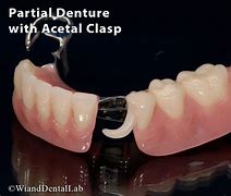 Image result for Partial Denture Clasps