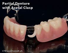 Image result for partial denture clasps materials