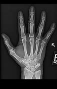 Image result for Dislocated PIP Joint in Pinky Finger