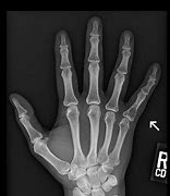 Image result for Dislocated Pinky Finger