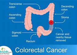 Image result for Adenocarcinoma Rectal Cancer