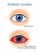 Image result for Uveitis Eye Disease