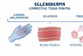 Image result for Scleroderma Microscopic