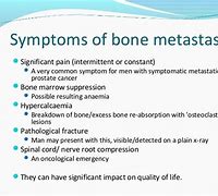 Image result for Bone Metastases