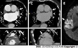 Image result for Cardiac CT Left Atrial Appendage Thrombus