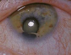 Image result for Cat Eye Syndrome