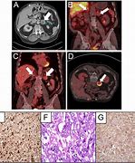 Image result for Large Pheochromocytoma CT