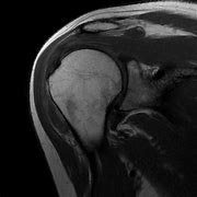 Image result for Scapulothoracic Bursitis MRI