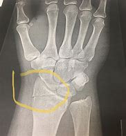 Image result for Radius Fracture