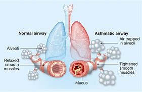 Image result for Asthma Painting